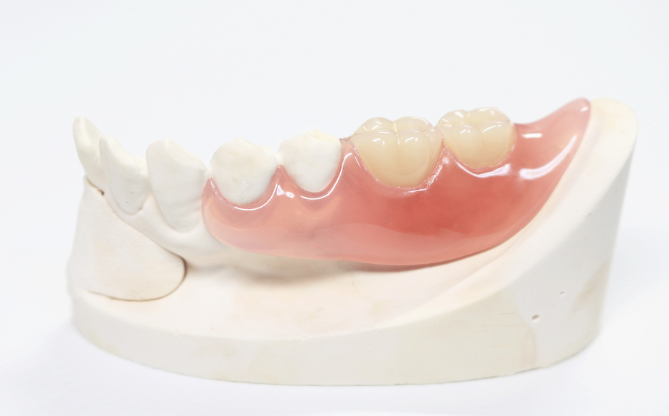 ノンクラスプデンチャー