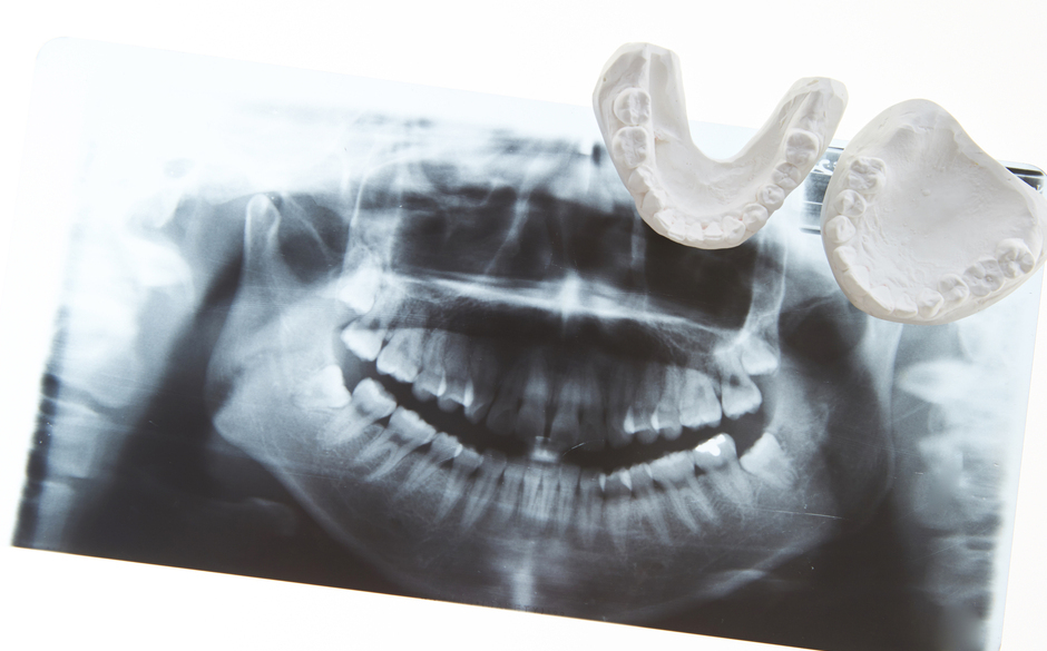 かみ合わせの調整