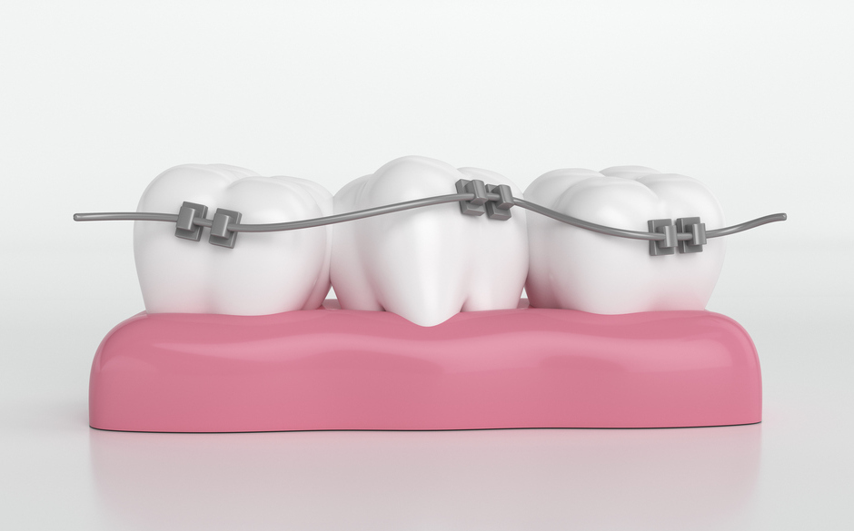 矯正装置の装着