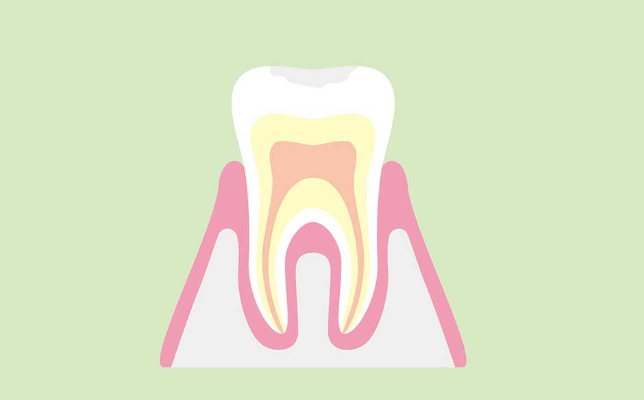 初期むし歯（CO）