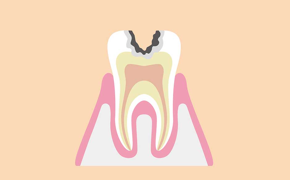 象牙質まで進行したむし歯（C2）