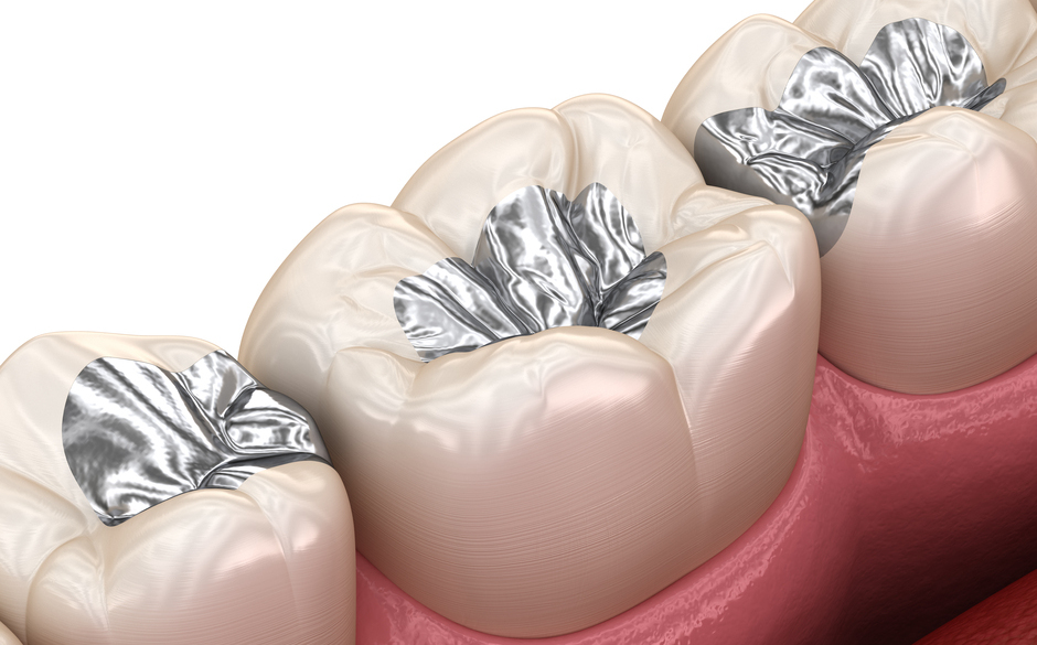 金属の詰め物・被せ物（銀歯）