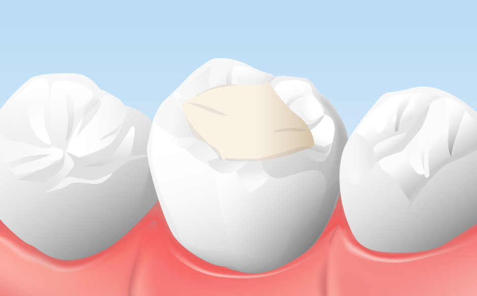 レジンの詰め物