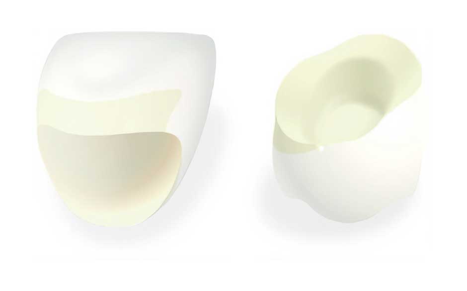 ハイブリッドの詰め物・被せ物