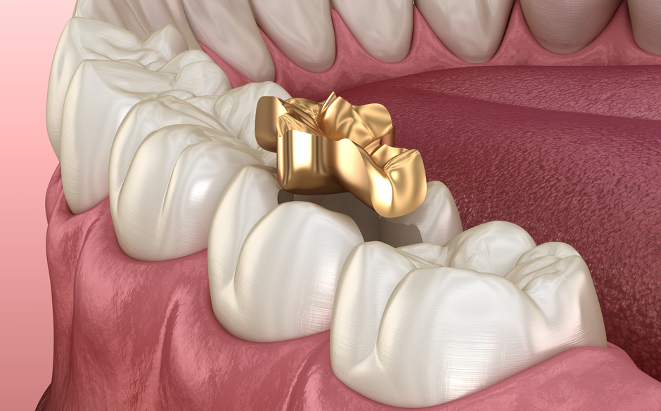 ゴールドの詰め物・被せ物