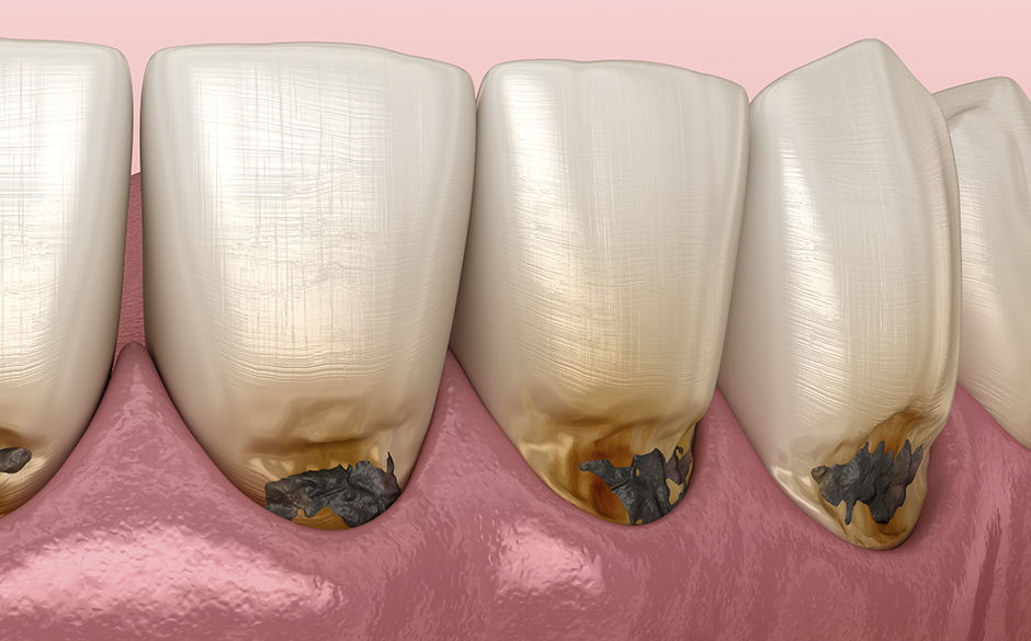 大人のむし歯の特徴